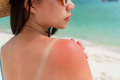 woman at beach with sunburn on shoulder
